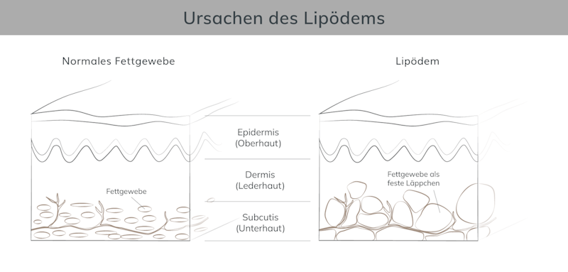 Ursachen Lipödem 